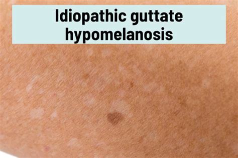 Idiopathic Guttate Hypomelanosis Vs Tinea Versicolor