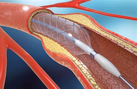 Heart Cath Procedure Anesthesia at Jo Mendes blog