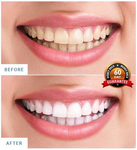Cleaner Smile Whitening Kits Reviews 2021: Is This Teeth Whitening Medical Approved By Dentists ...