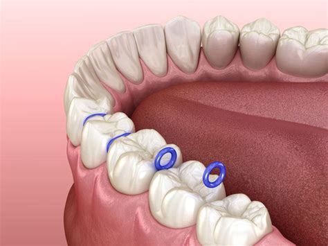 Why You Need Orthodontic Spacers - Koch Orthodontics