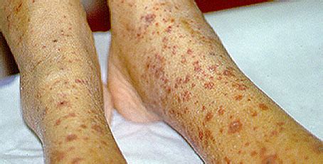 Pictures Of Vasculitis On Skin