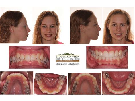 Invisalign Before And After Crowding