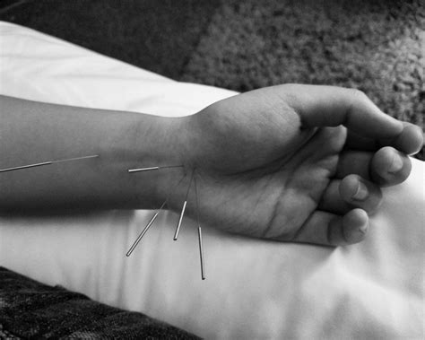 Acupuncture Can Ease Wrist Pain of Carpal Tunnel Syndrome - Acupuncture ...