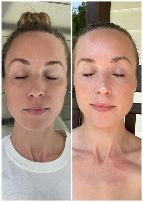 My MOXI Laser Treatment Review with Before & Afters – Natalie Yerger