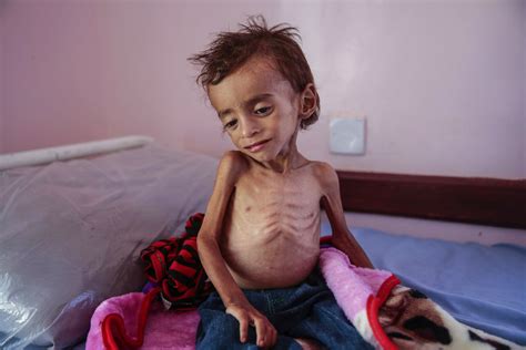 Aid group: 85,000 children may have died of hunger in Yemen - Sentinel ...