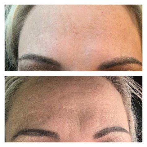 Dermarolling Before and After Pics - Dermarolling for Scars and Acne ...