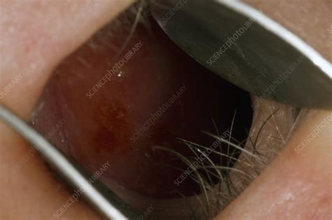 Inflamed mucosa in the nose - Stock Image - C004/4237 - Science Photo ...