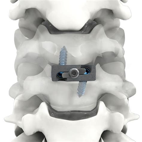 Cervical interbody fusion cage - PRO-LINK® - Life Spine - anterior ...