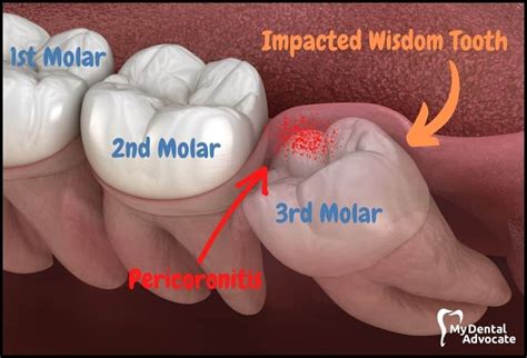 Impacted Wisdom Teeth: Symptoms, Causes, Removal & Recovery