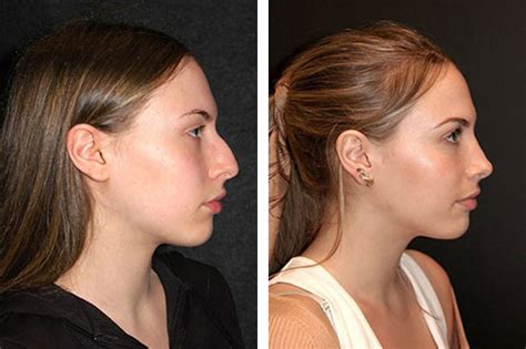 Rhinoplasty nose job – Artofit