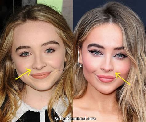 Sabrina Carpenter Plastic Surgery Comparison Photos