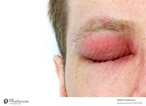 a man with swollen eye from a bee sting - a Royalty Free Stock Photo from Photocase