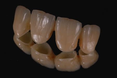 crowns zirconia Cercon ht