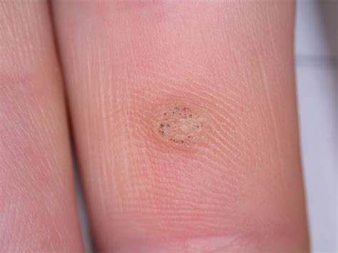 Viral warts - Dr Jonathan Bowling