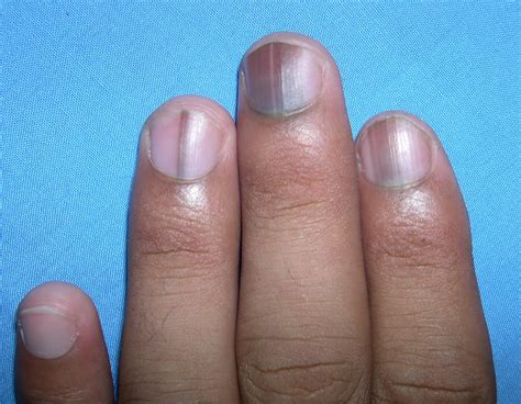 What Causes Black Lines On My Fingernails at Gerald Buckley blog