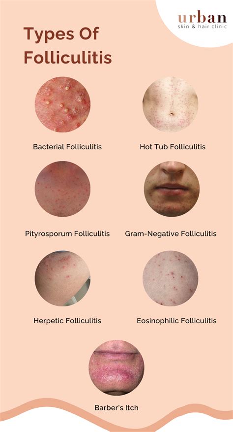 Folliculitis Types, Causes, Symptoms & Treatment | USHC