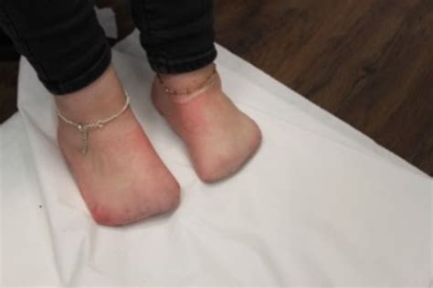 Toe Prosthetic Case Study - Billy – Ledbrook Clinic