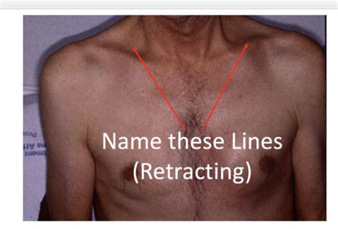 Respiratory N246 Flashcards | Quizlet