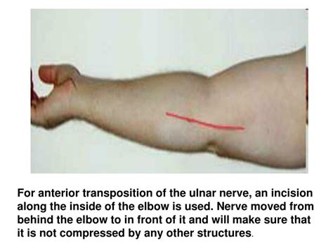 PPT - Peripheral nerve injuries PowerPoint Presentation, free download - ID:521215