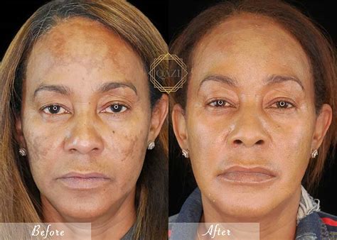 Hydroquinone Before And After Black Skin