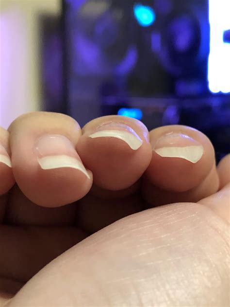 How do I prevent my nails from curling like this? Only these two nails, possibly from being on ...