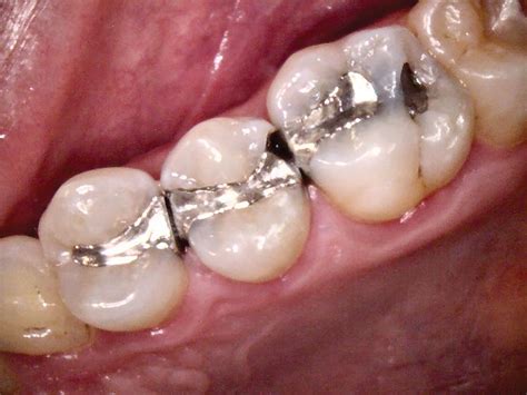 How to Repair Amalgam Restorations With Recurrent Caries