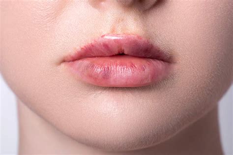 Bruising After Lip Filler: Causes and Treatments | VibrantSkinBar