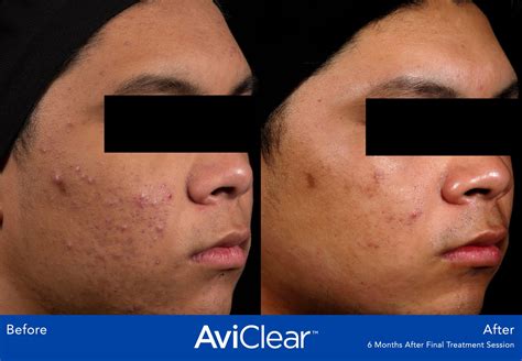 AviClear Before & After Photos | VITAHL Chicago