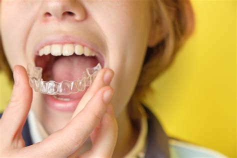 Clear Aligners | American Association of Orthodontists