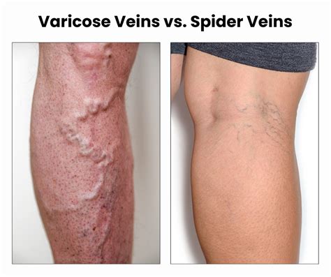 Should I Be Concerned About Dark Veins? - Downtown Vein & Vascular