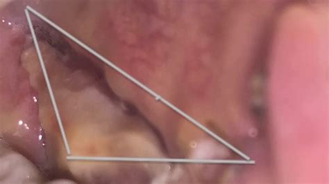 Buccal Graft Healing - YouTube