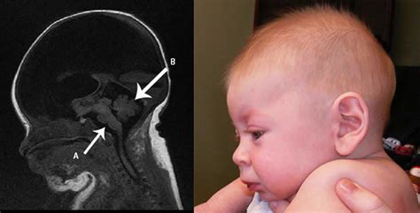 Hydranencephaly causes, signs, symptoms, diagnosis & treatment