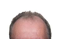 For Baldness, Turning to Leg Hair - The New York Times