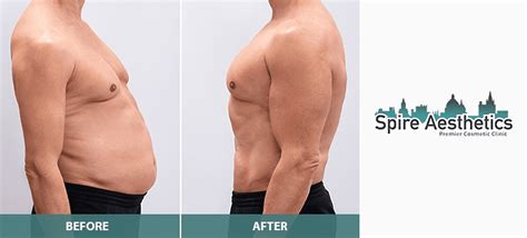 Before & After Cryolipolysis - Spire Aesthetics Chippenham