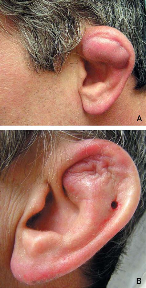 Figure 2 from Successful treatment of auricular pseudocyst using a surgical bolster: a case ...