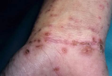 What Are Scabies? Rash, Treatment, Symptoms, Pictures