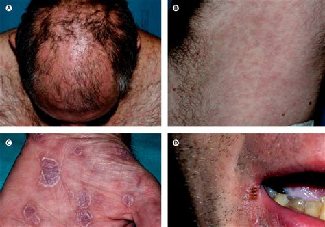 Secondary syphilis - The Lancet Infectious Diseases