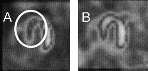 Thallium 201 myocardial scan done in a patient with stage 2 sarcoidosis... | Download Scientific ...