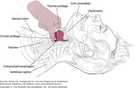 Compromised Airway | Anesthesia Key