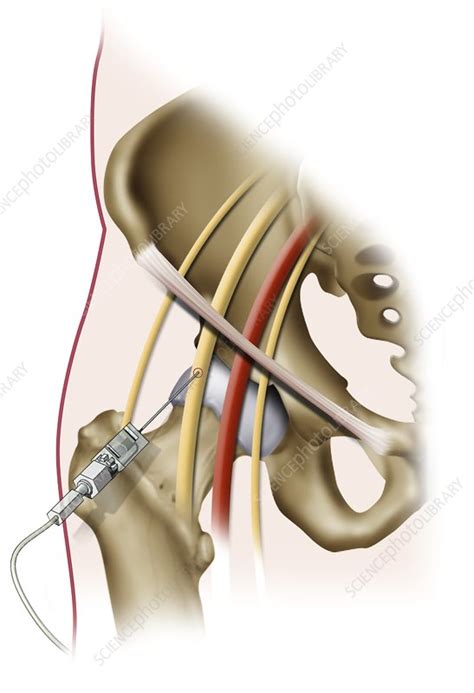 Femoral nerve block injection, illustration - Stock Image - C046/3004 - Science Photo Library