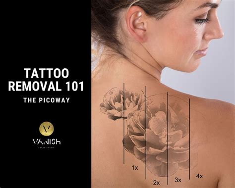 PicoWay Tattoo Removal 101 - Best Laser tattoo removal clinic Toronto