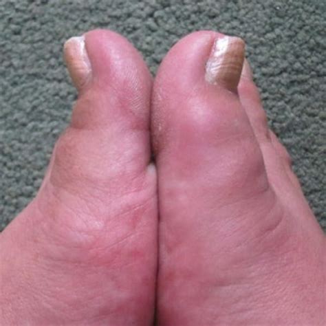5 Facts About Gout