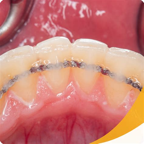 Removable vs. Permanent Retainers - Smile Every Day Dentistry