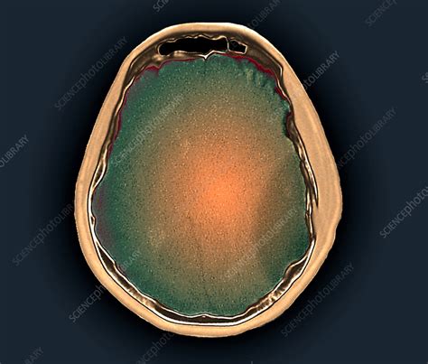 Skull fracture, CT scan - Stock Image - C055/2658 - Science Photo Library