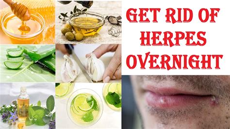 How To Cure Herpes Overnight | Natural Home Remedies For Removal Of ...