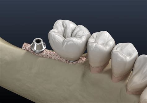 Ridge Augmentation • Carson Periodontics And Oral & Maxillofacial Surgery