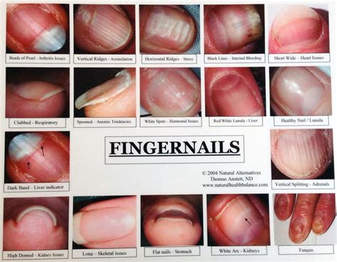 1. Fingernail with disorder | Nail health signs, Fingernail health ...