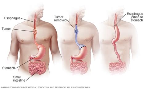 Esophageal cancer surgery - Mayo Clinic