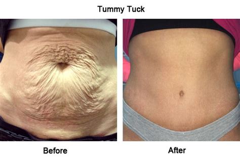 Understanding tummy tuck surgery (Abdominoplasty): Types, recovery, costs and risks | Cosmetic ...