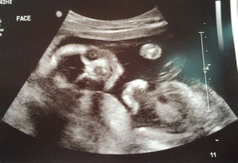 Funny Ultrasound Picture - Funny PNG